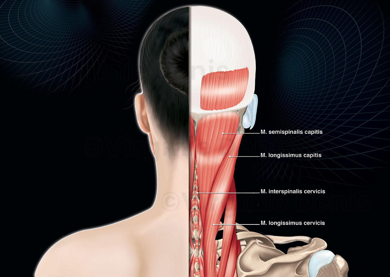 Cervical dystonia, muscles intermédiaires du cou