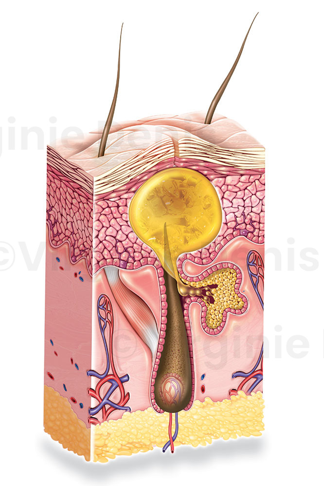 Illustration médicale - Évolution du comédon