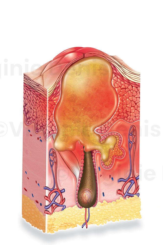 Évolution du comédon - Illustration medicale