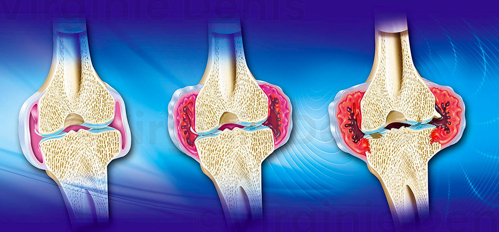Illustration médicale : La polyarthrite rhumatoïde