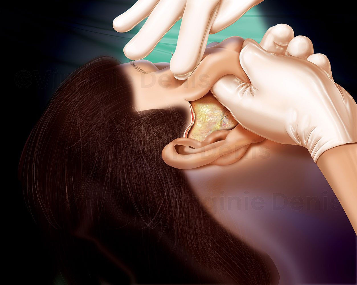 Illustration médicale : Lifting du visage
