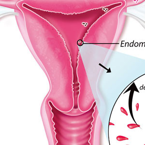 Endométriose