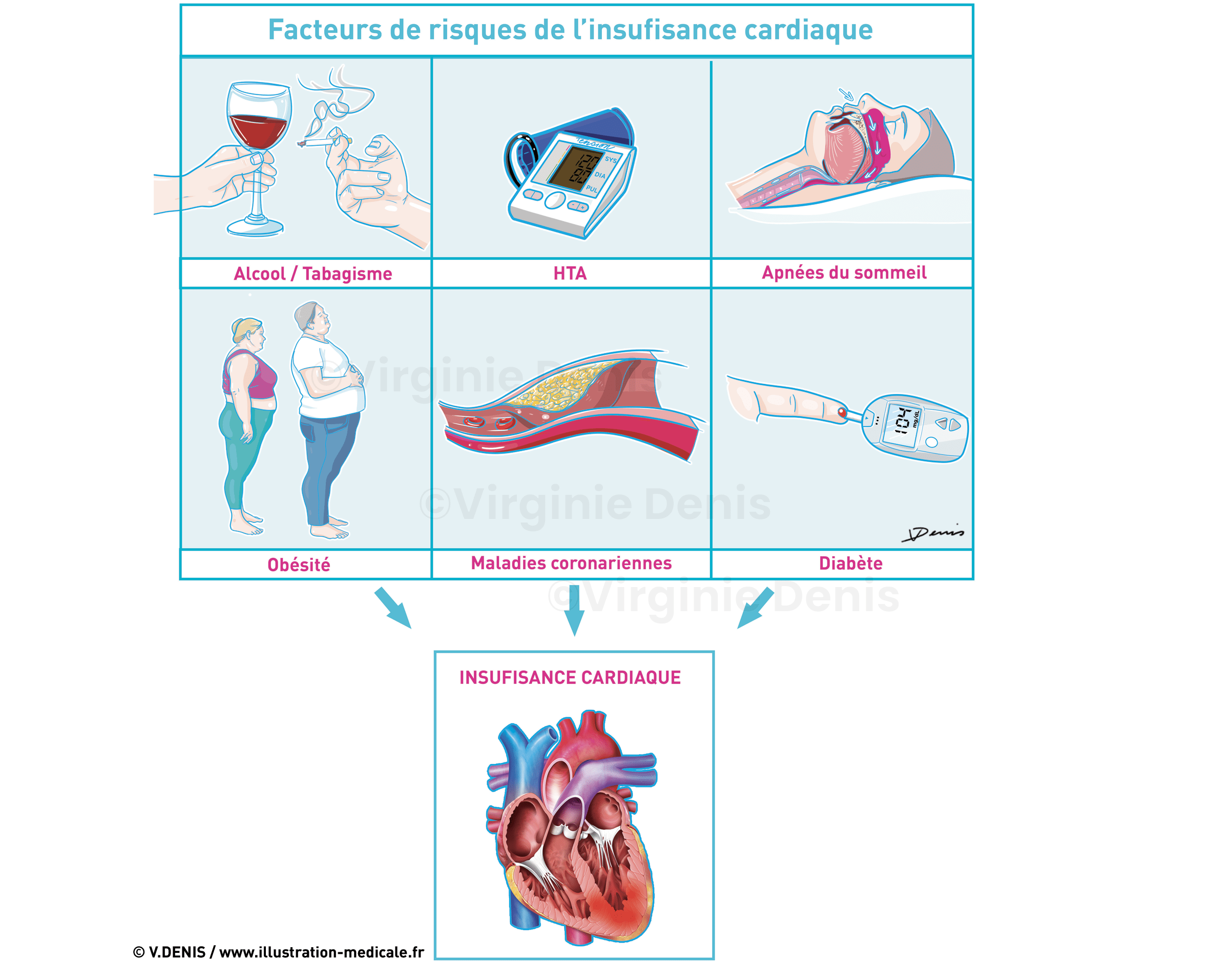 Illustration médicale : Insuffisance cardiaque - facteurs de risque