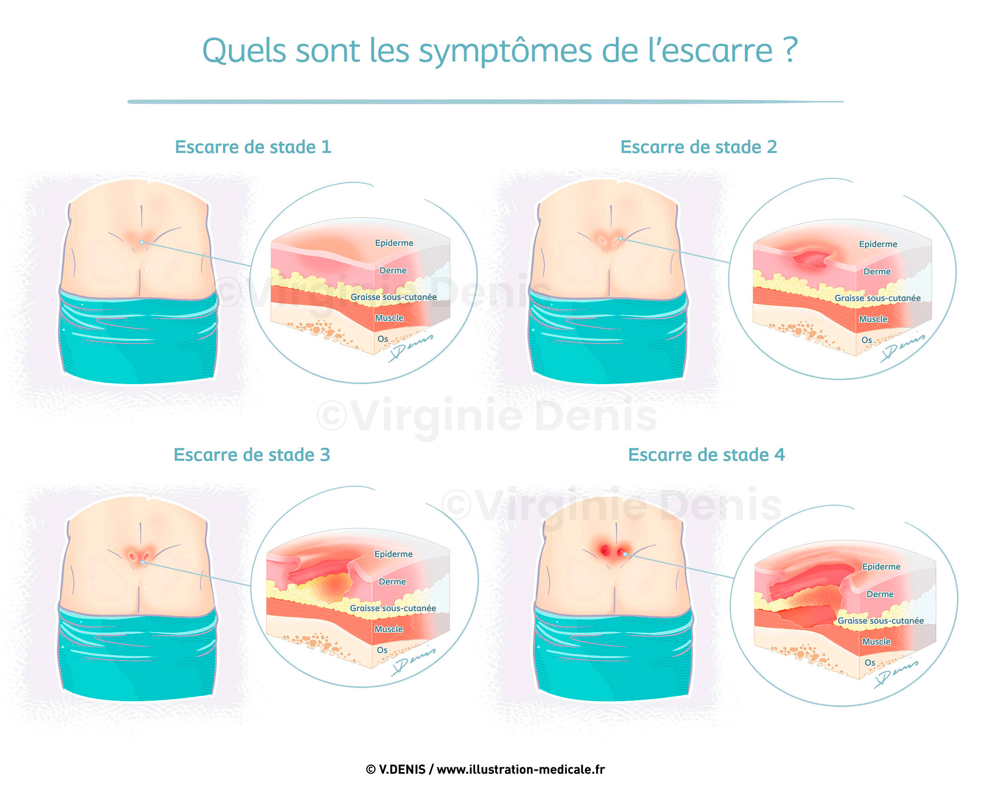 illustration médicale - les 4 stades de l'escarre