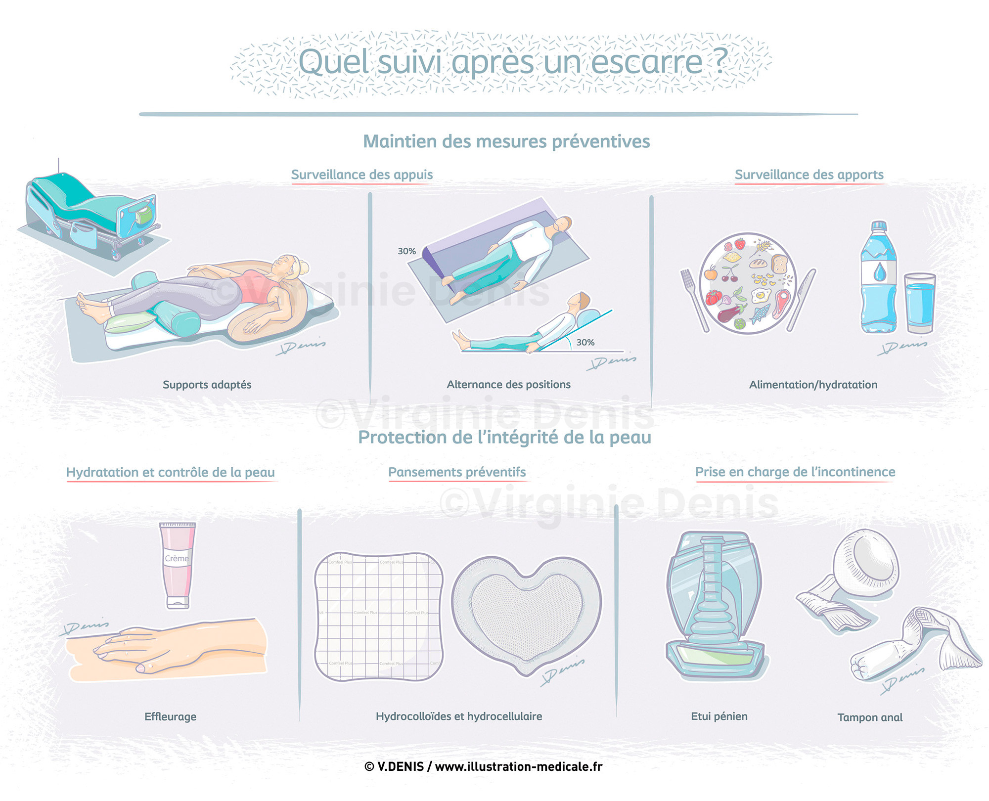 Illustration médicale : Prévention et prise en charge des patients atteints d'escarre