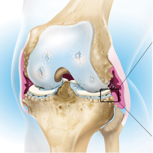 Arthrose du genou