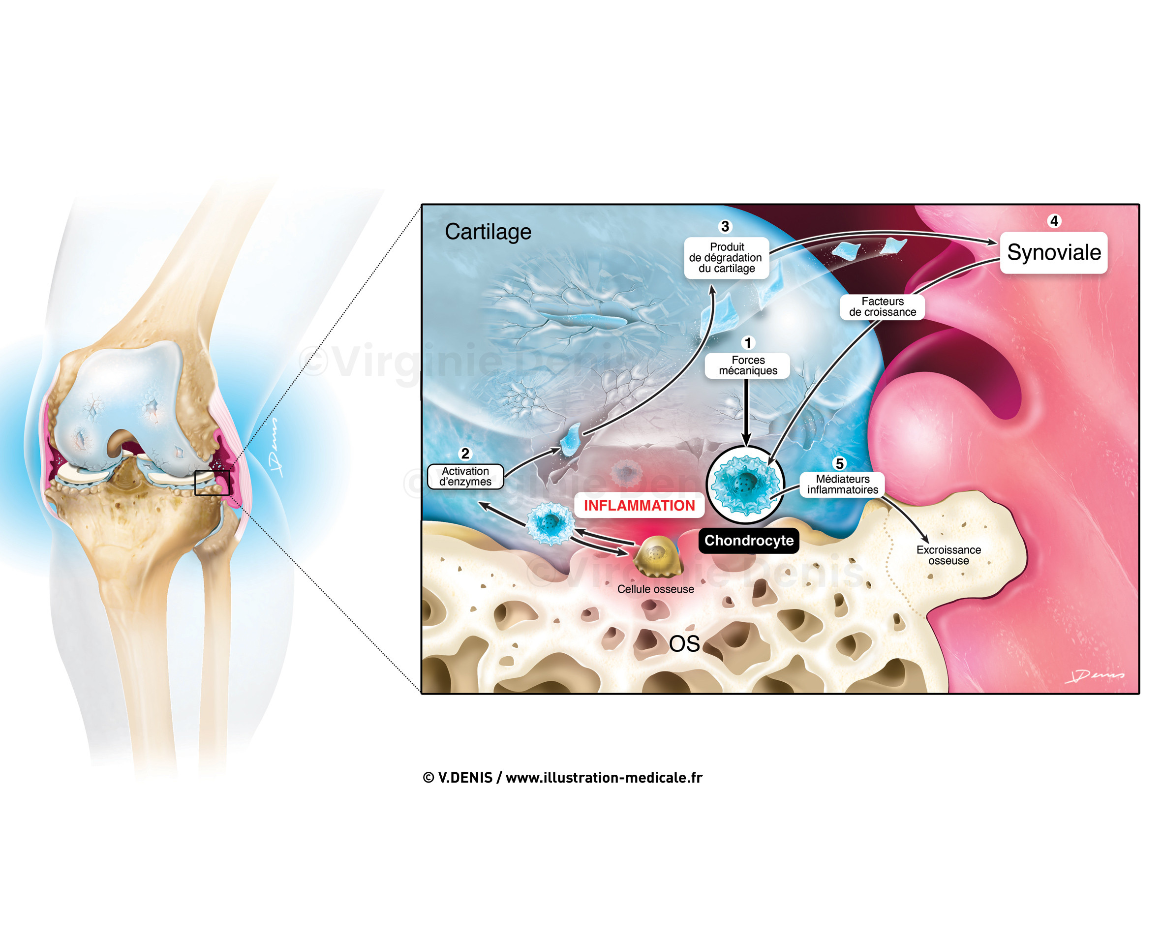 Illustration médicale : arthrose du genou - physiopathologie de l'arthrose