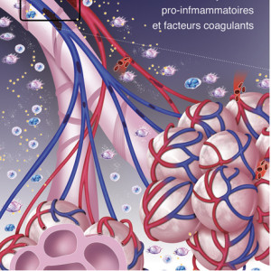 Covid 19 - Cascade inflammatoire en réponse au SARS-CoV-2 - formation de thrombus et hémorragies pulmonaires