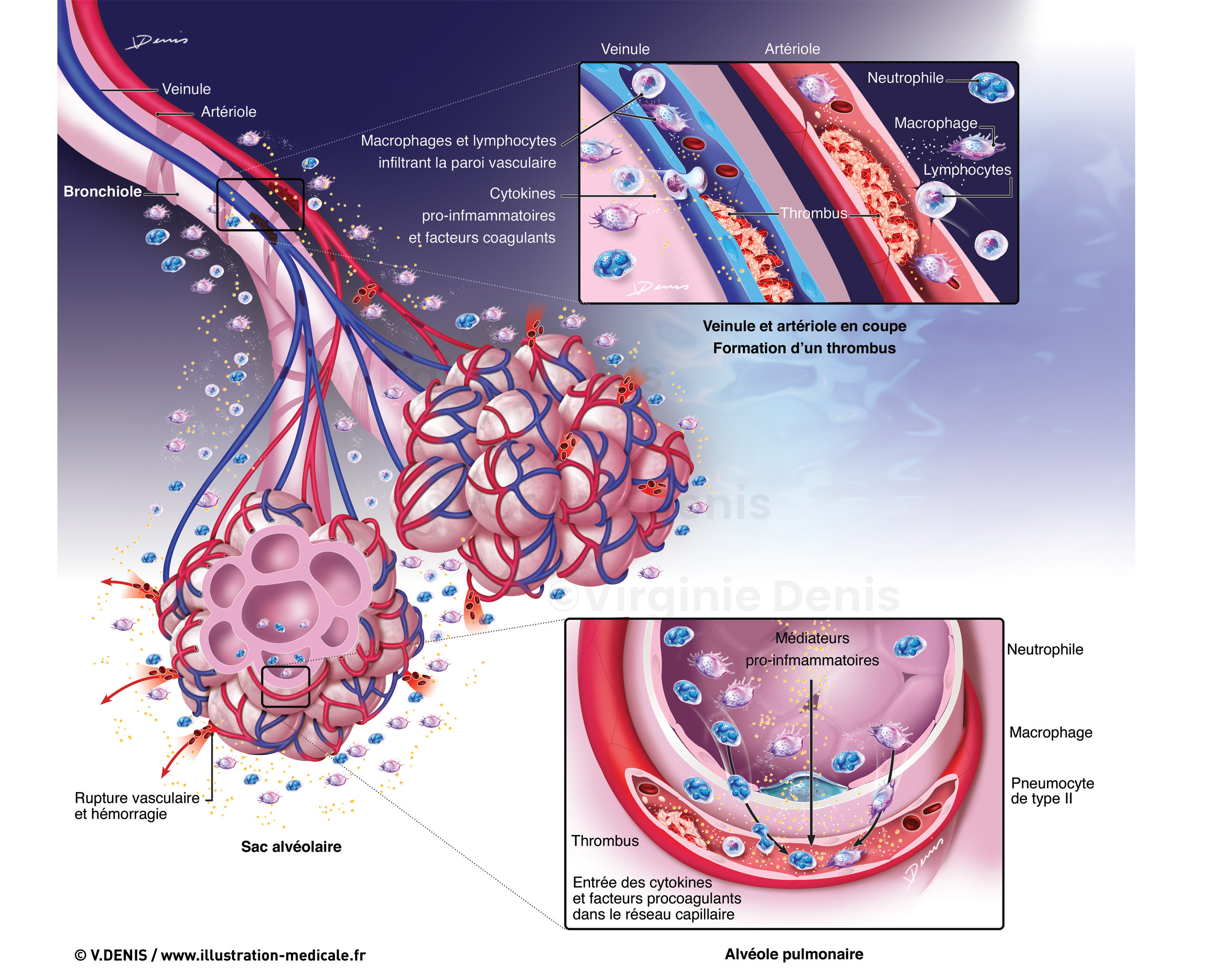 Covid 19 - Réaction immunitaire au SARS-CoV-2 - formation de thrombus et hémorragies pulmonaires