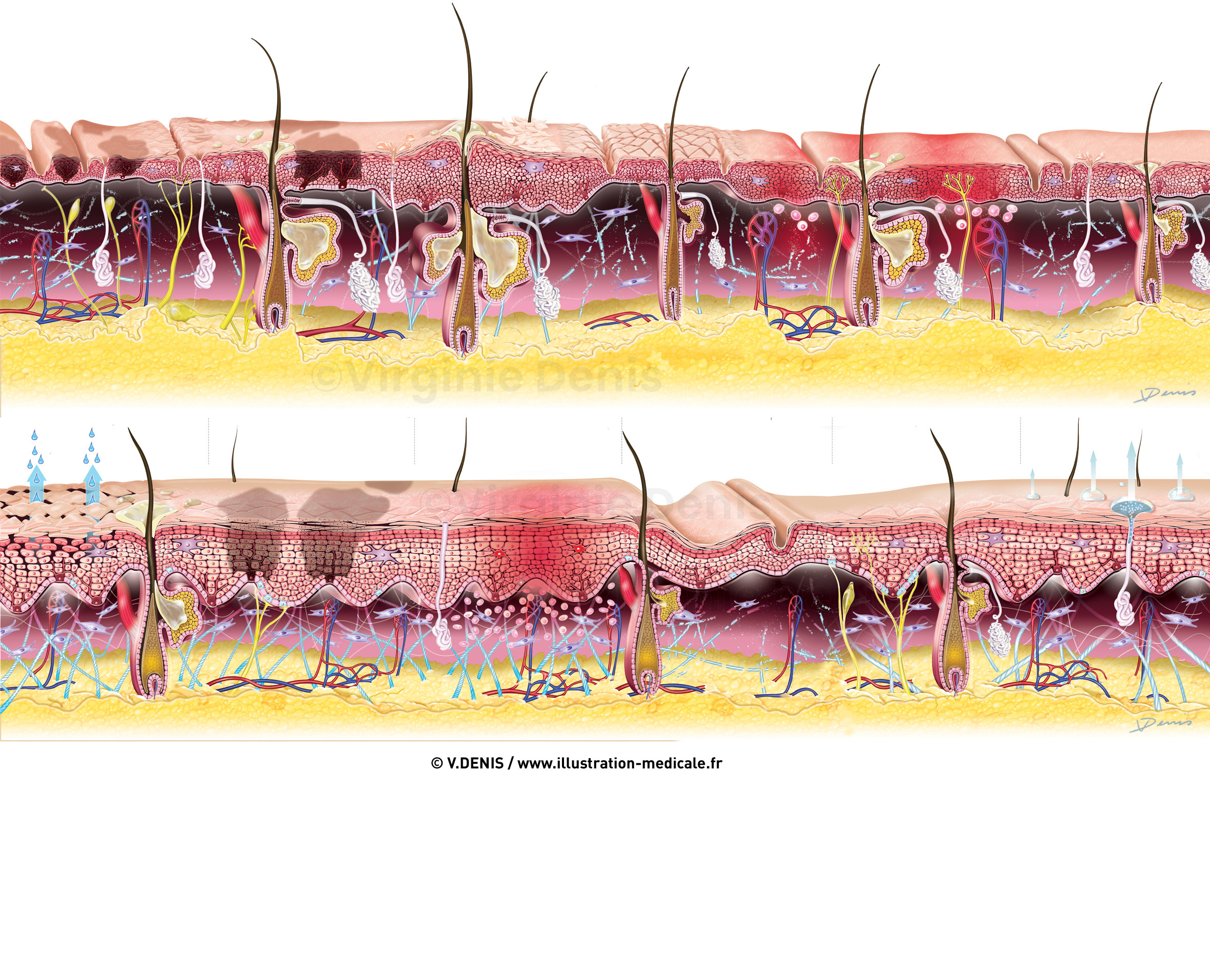 Illustration médicale : coupe de peau pathologies