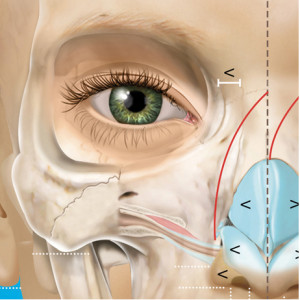 Chirurgie esthétique - Asymétrie faciale