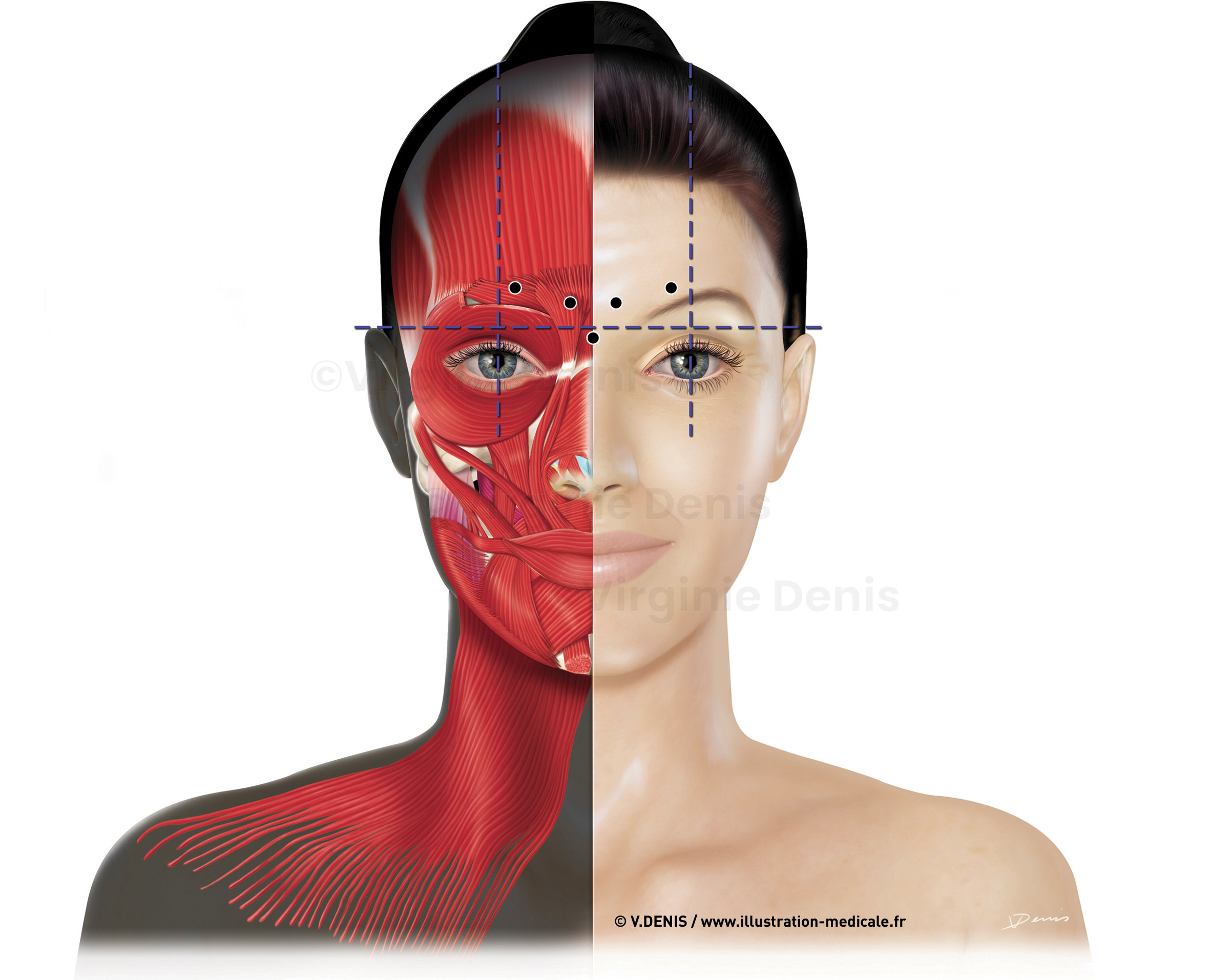Anatomie de la face - points d'injection Toxine Botulique