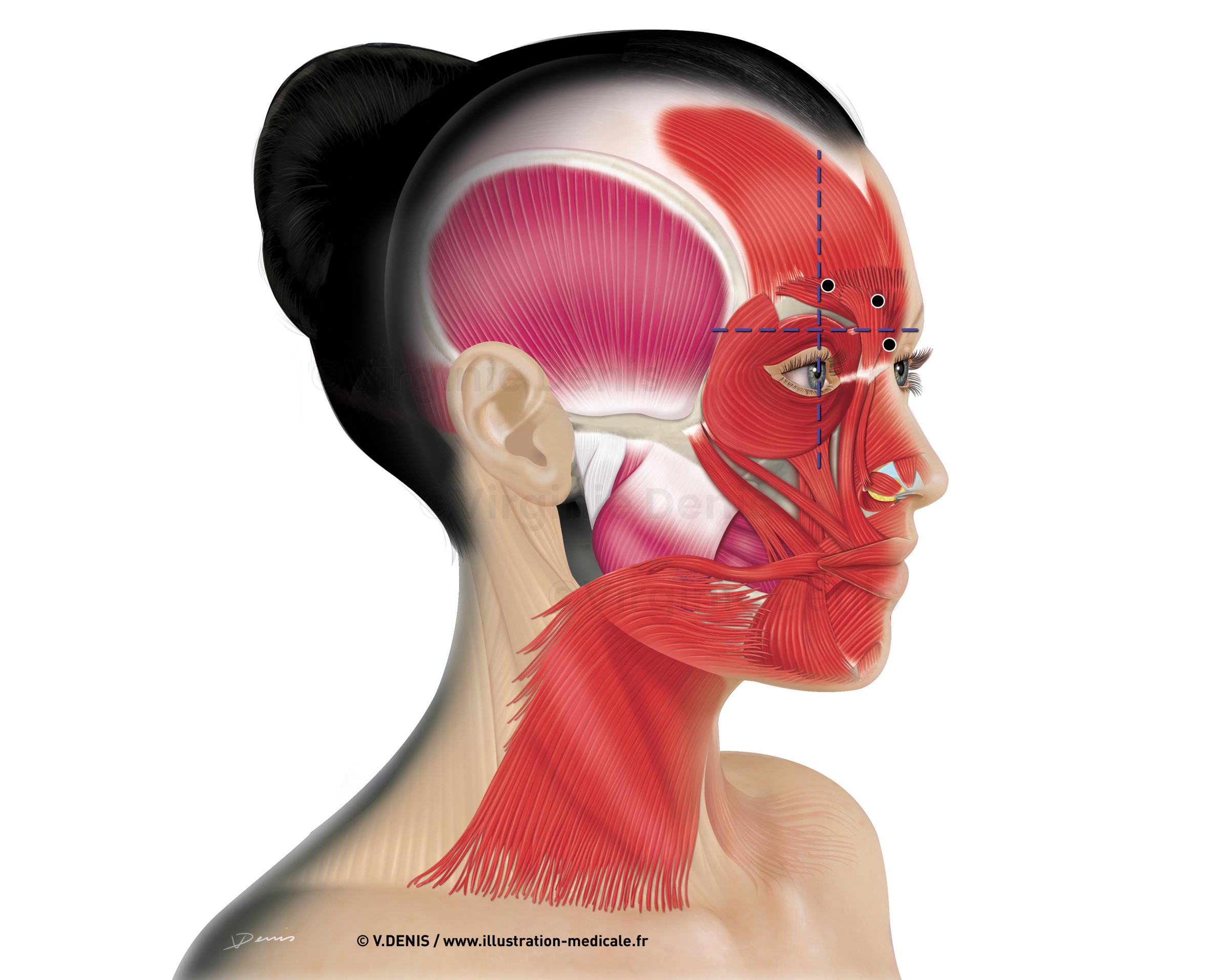 Anatomie de la face profil - points d'injection Toxine Botulique