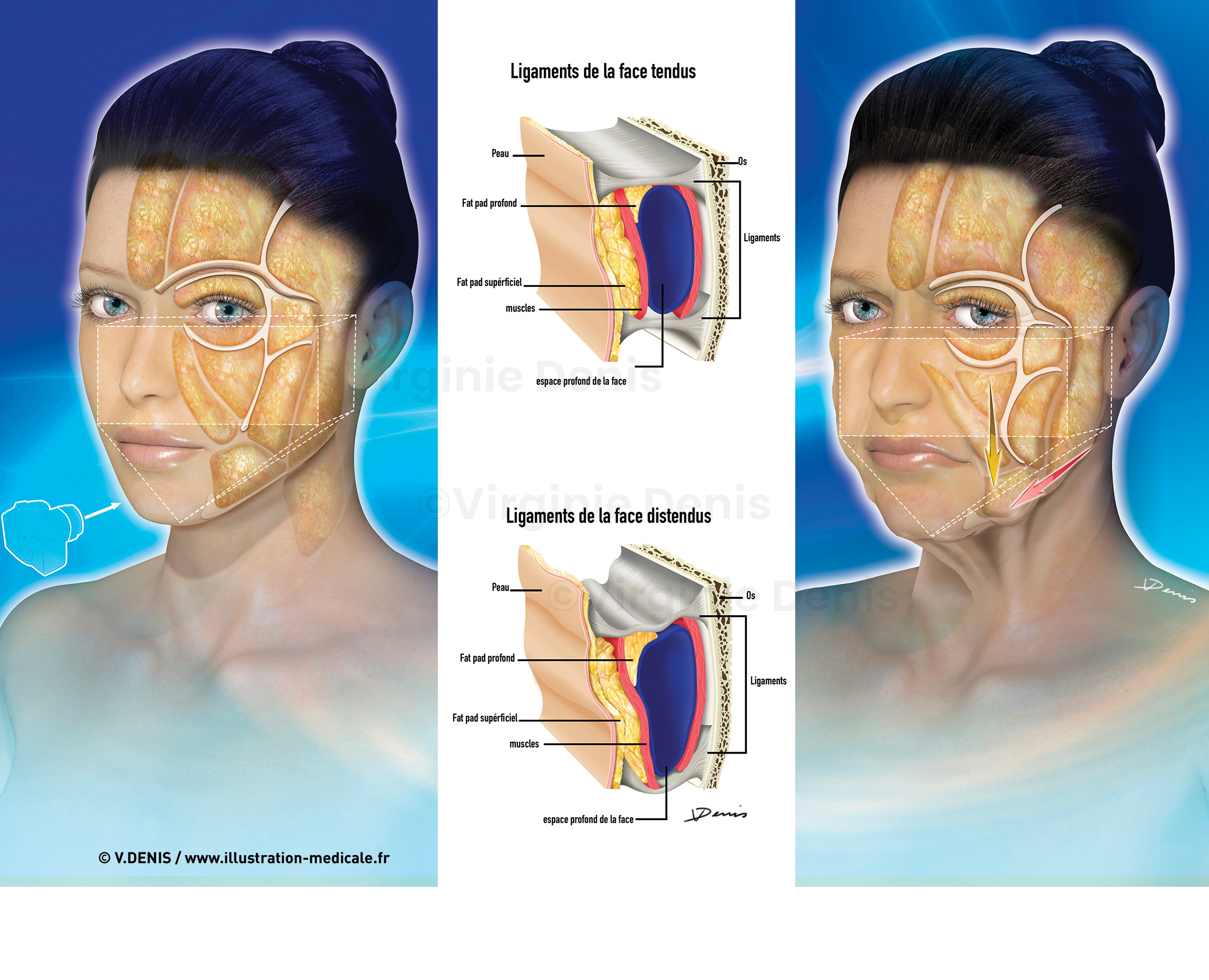 illustration médicale : compartiment graisseux de la face, relâchement des ligaments de la face