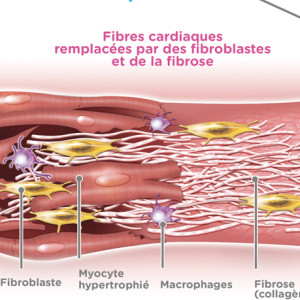 Illustration médicale : L'insuffisance cardiaque - Dilatation et hypertrophie du ventricule gauche