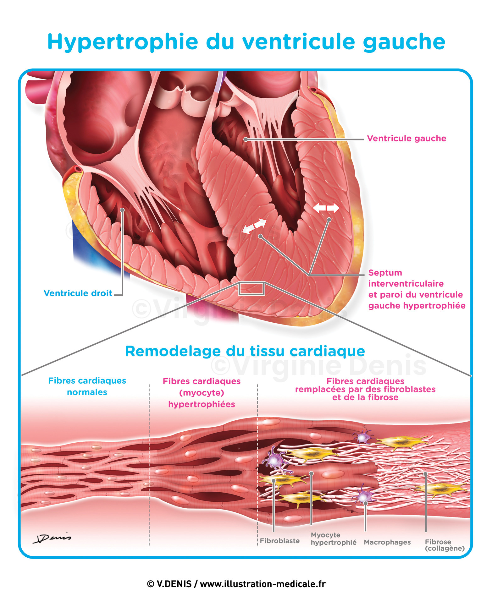 Dilatation du ventricule gauche - insuffisance cardiaque
