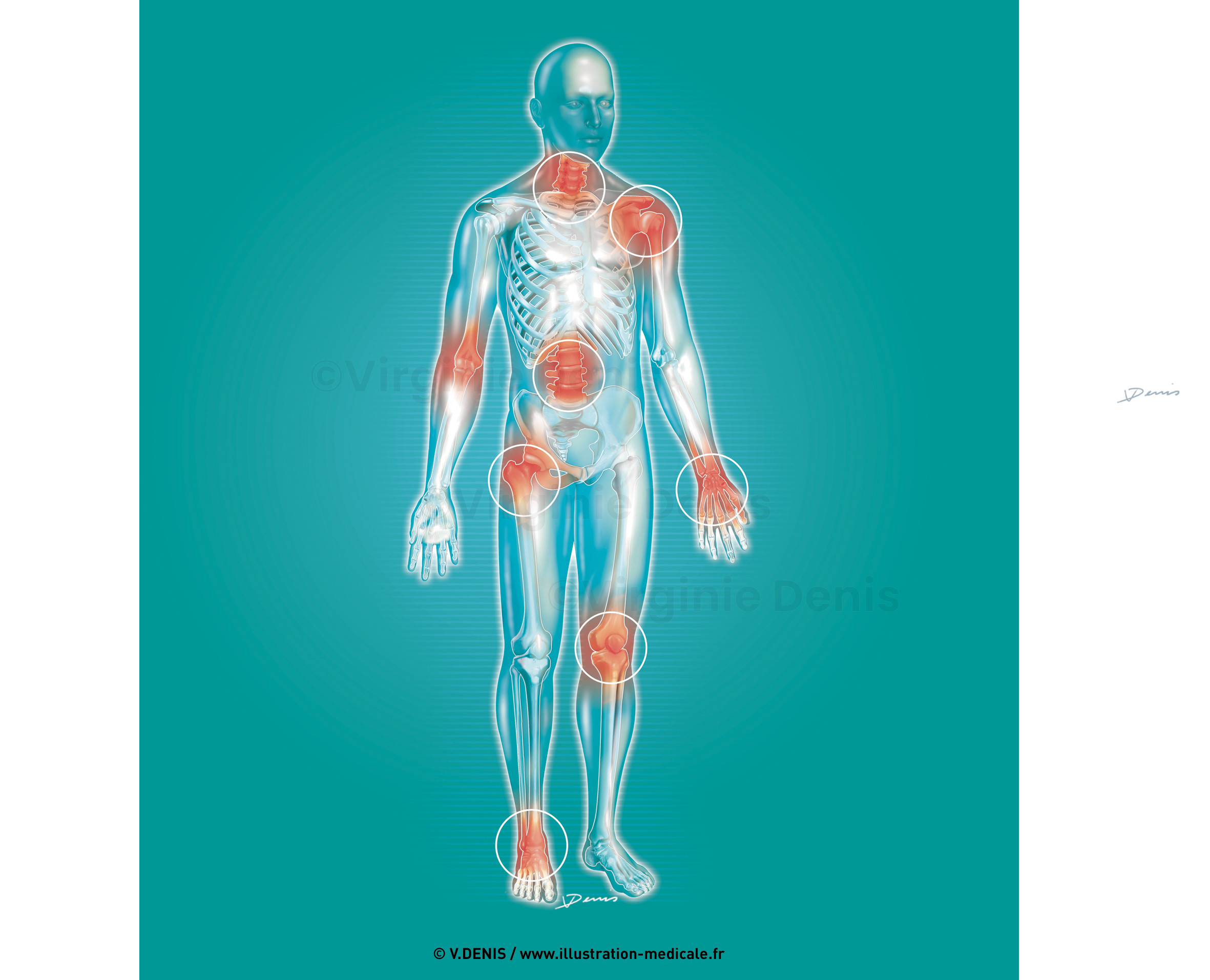 Articulations douloureuse - Arthrose