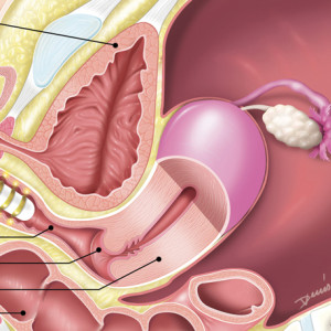 Sonde de radiofréquence - Traitement de la sécheresse vaginale