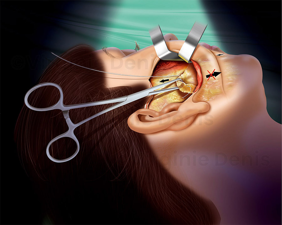 illustration médicale lifting visage chirurgie esthétique